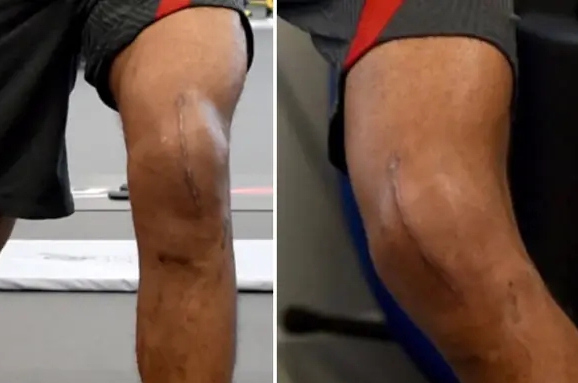 Joe Gomez's knee after the knee surgery.