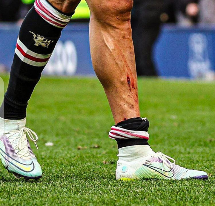 Cristiano Ronaldo shows off his bruised leg. 