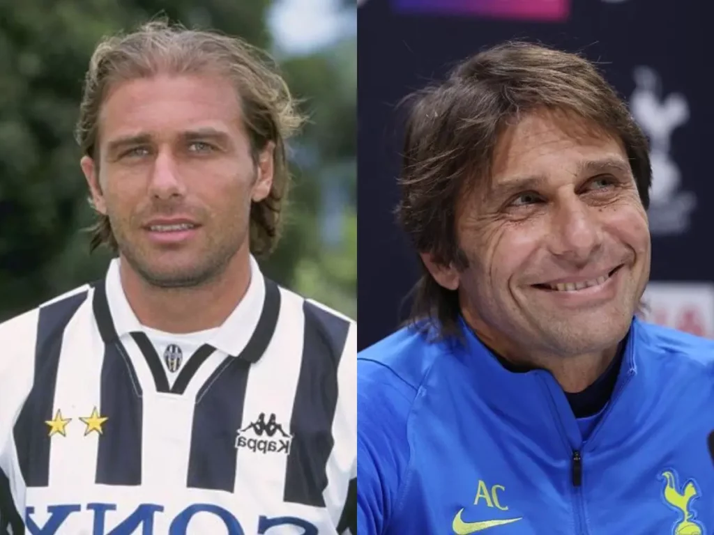 Before and after picture of Antonio Conte's hair transplant